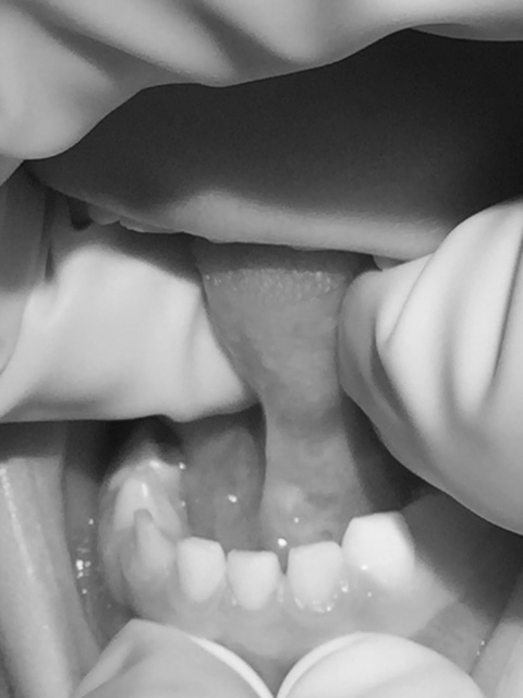 Tethered Oral Tissues (TOTs)