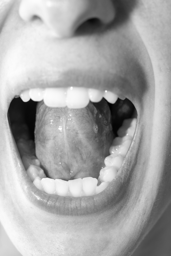 Tethered Oral Tissues